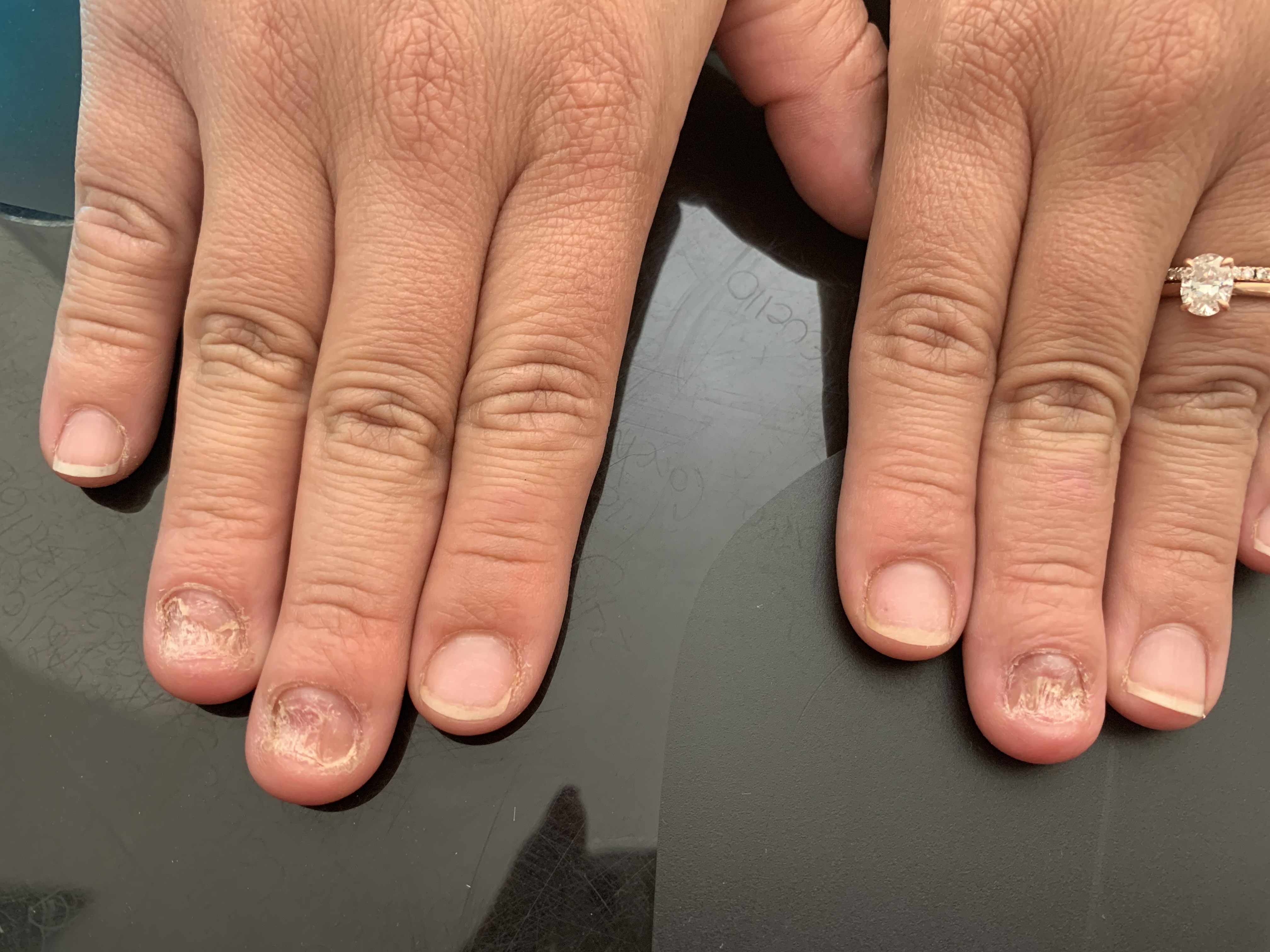 Removal nail fungus(onychomycosis) at PM Studio- Skin & Nails by Paola Mercado in Concord, CA