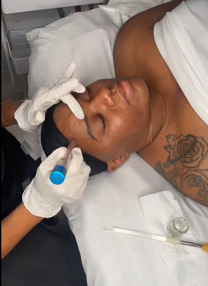 Serum Infusion/Intro Microneedling