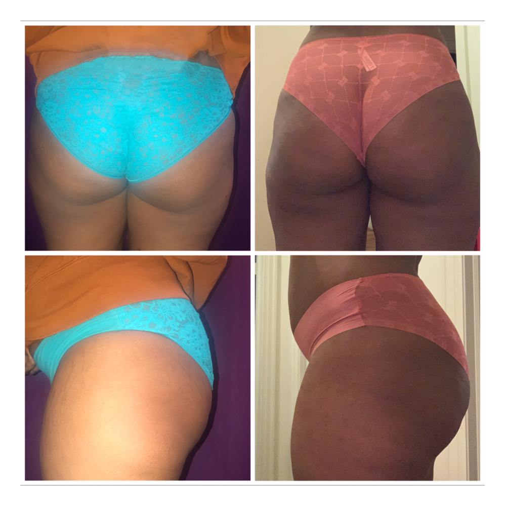 Stomach Injections/Butt Injections