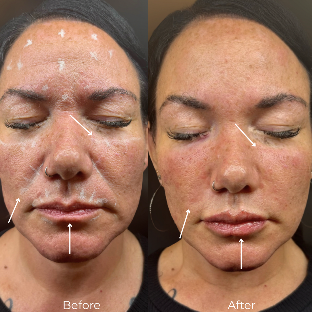 Nasolabial Fold Filler