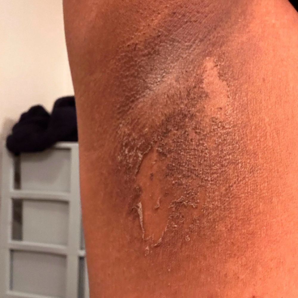Spicule Peel Intimate Brightening at I.S.M Aesthetics in Virginia Beach, VA