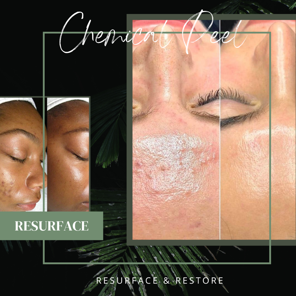 Chemical Peel