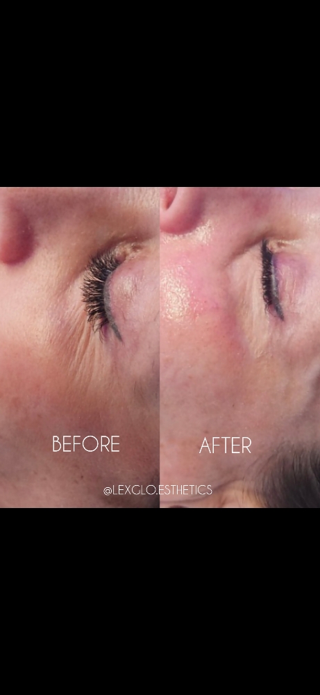 Add On - The Instant Face Lift