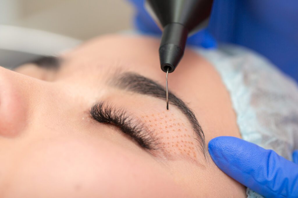 Fibroblast - Plasma Skin Tightening