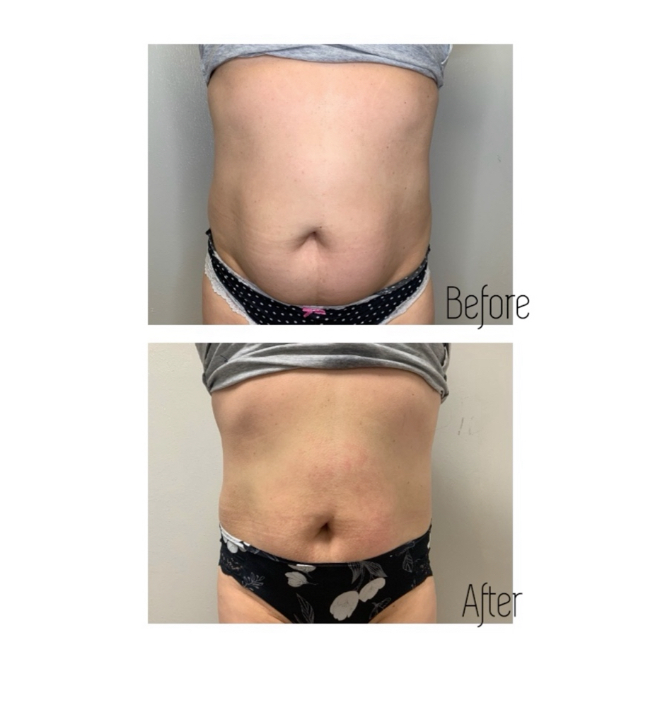 8 Cavitation Sessions