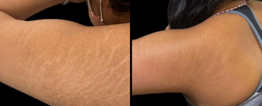 Inkless Stretch Mark Revision