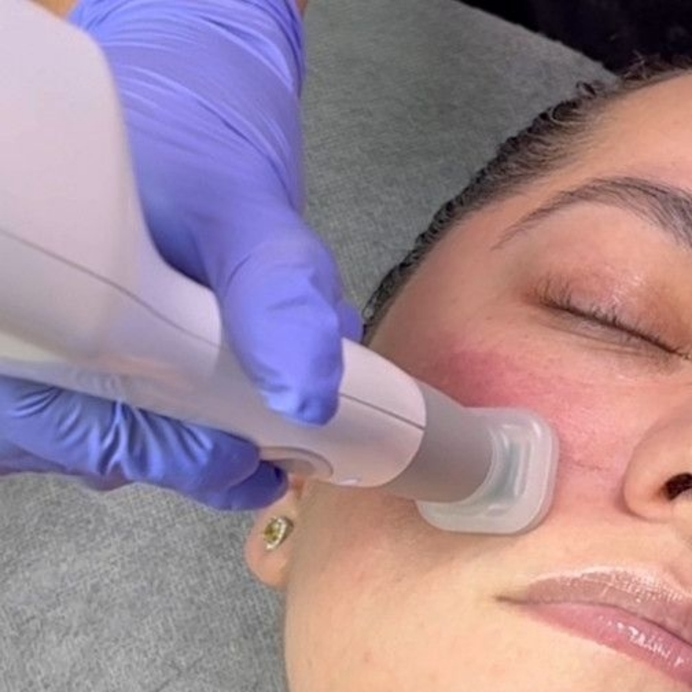 Jet Plasma Rejuvenation Facial at Haus of Glam by Karina J in Haverhill, FL