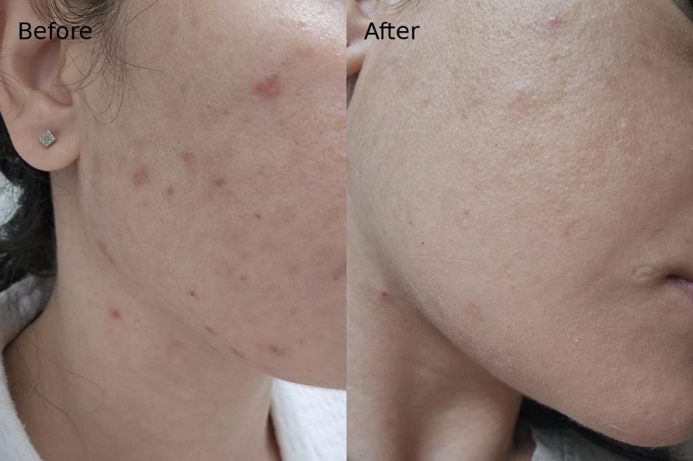 Cold plasma acne