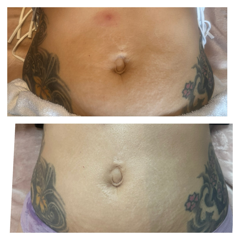 RF Skin Tightening/ Body sculpting