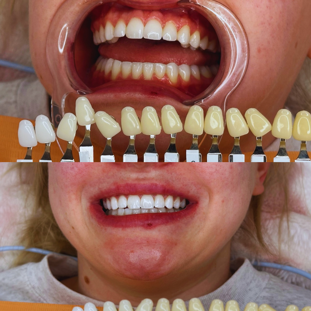 Teeth Whitening