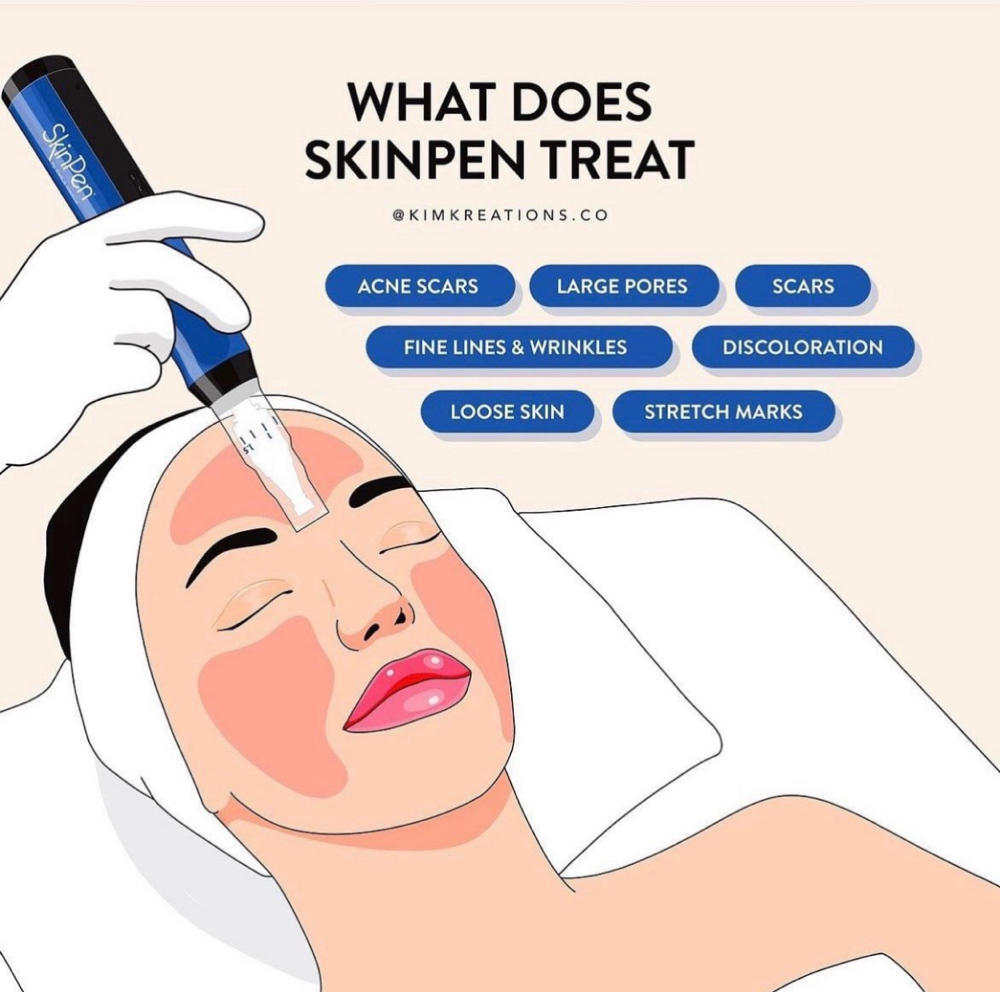 Microneedle Single Session