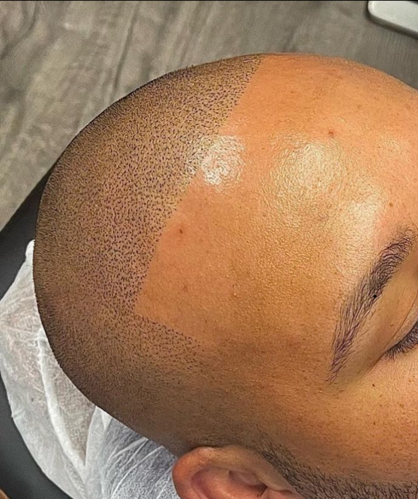 SMP (Scalp Micropigmentation)