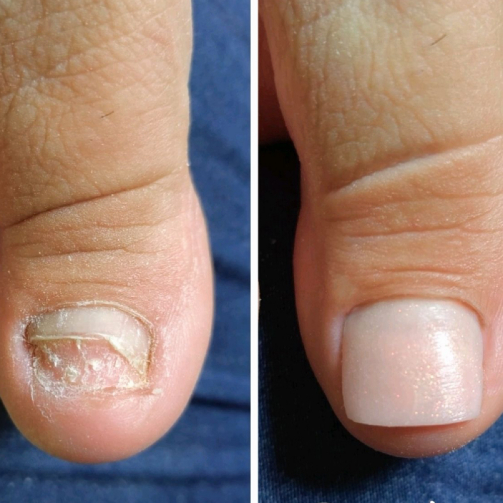 Big Toe Nail Repair (1toe) at Ambertipz in Raleigh, NC