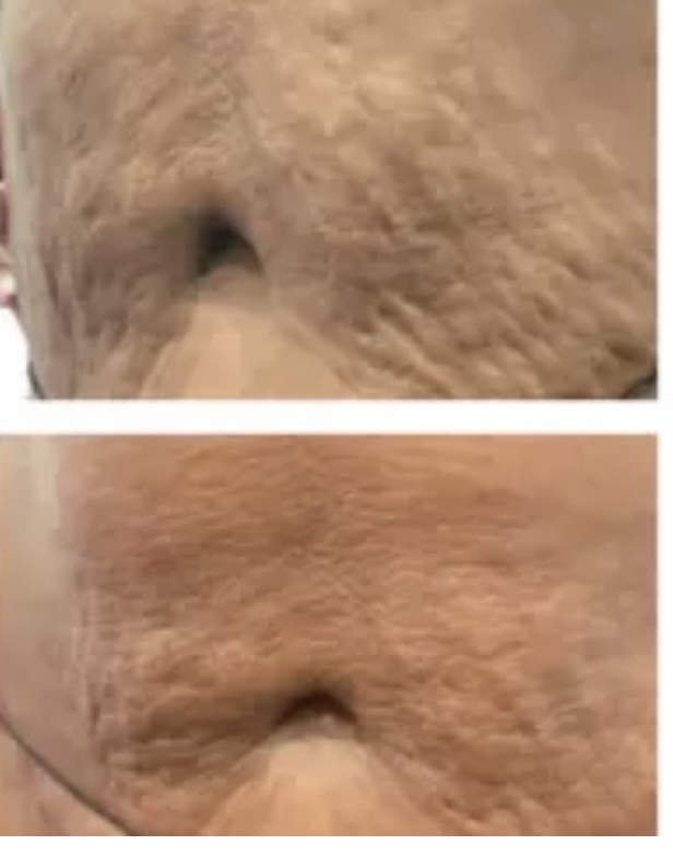 Stretch Mark Removal