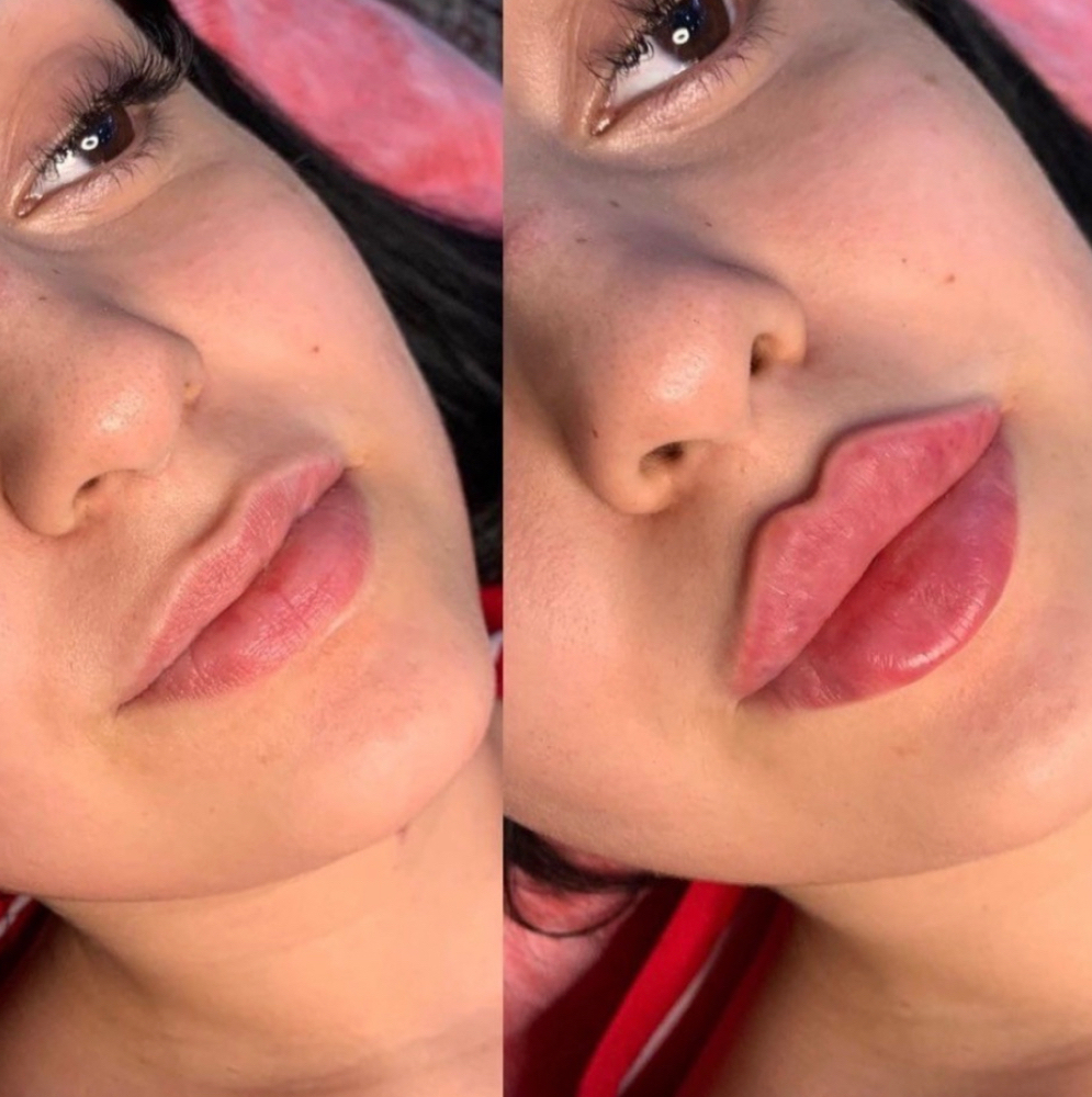 Lip Filler Half Syringe