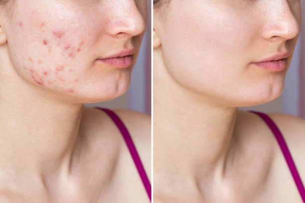Acne Clearing Facial