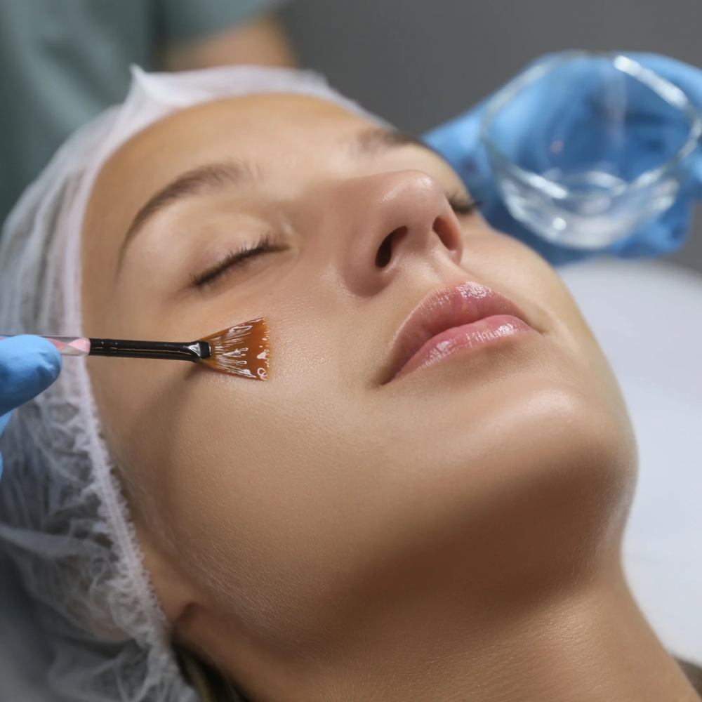 Chemical Peel