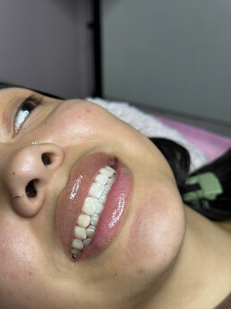 40 Min Teeth Whitening