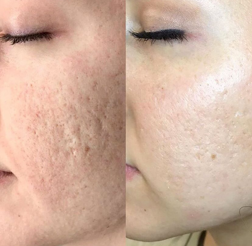 Procell Microchanneling Facial
