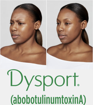 Dysport