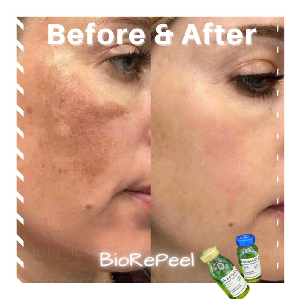 BioRePeel/Chemical Peel