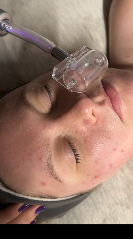 ⚡️Acne Killer Facial🔪