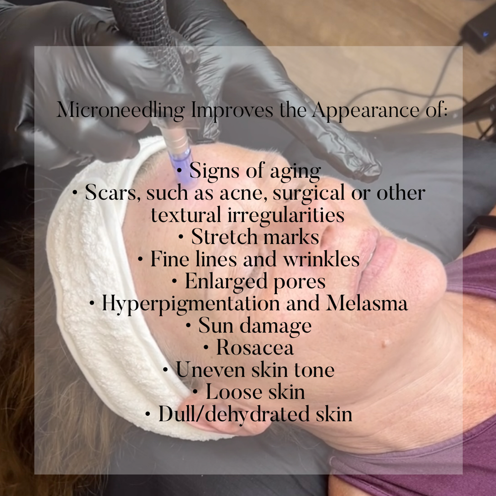 Microneedling