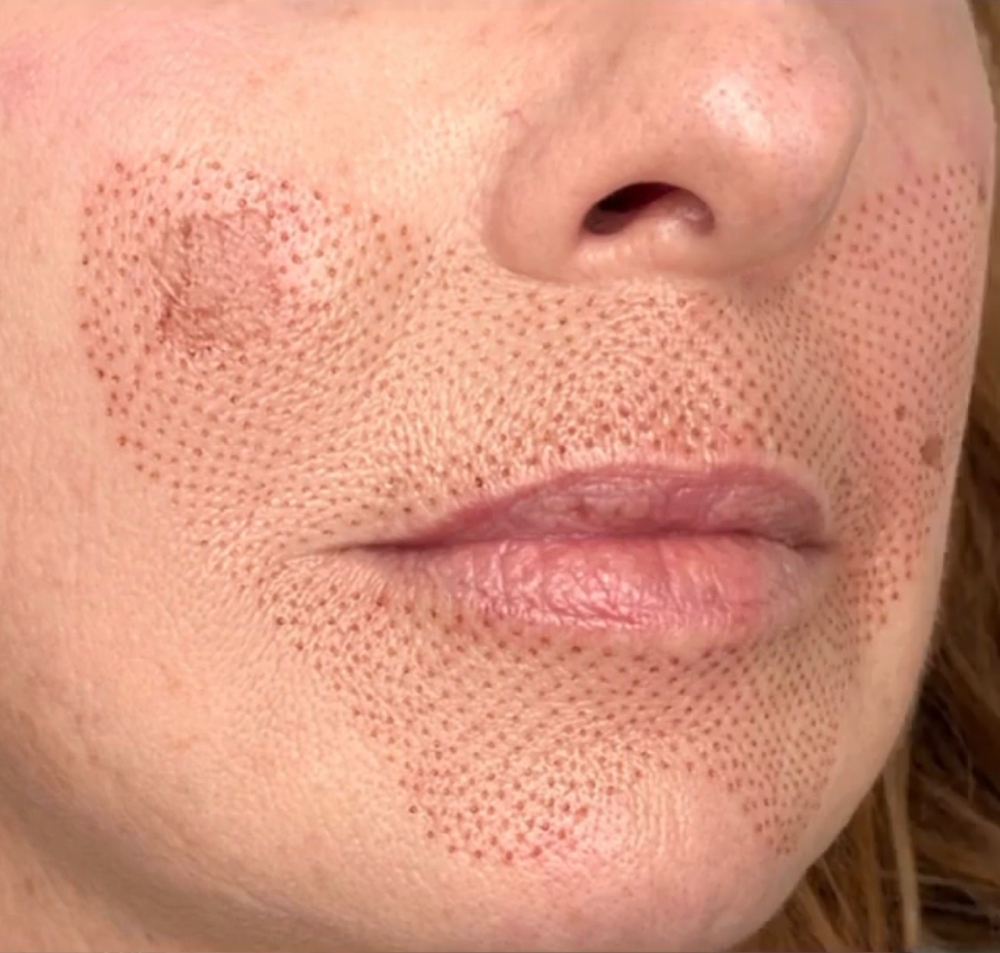 Nasolabial Folds Lip Flip