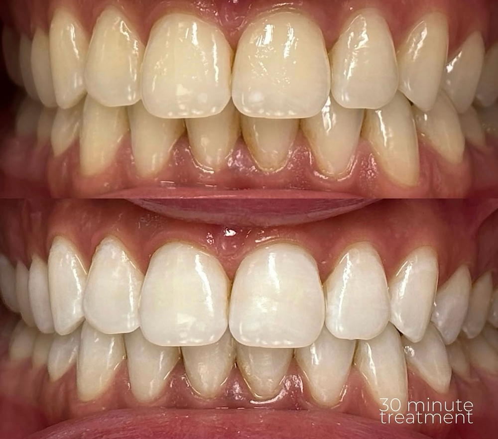Teeth Whitening- 30 Minute Session