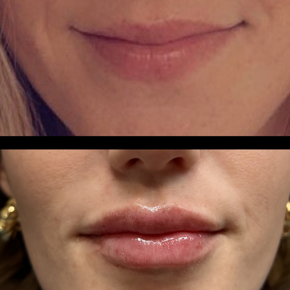 Signature Pout- Full Syringe Filler at Injections by Leighanna in Clarksville, IN