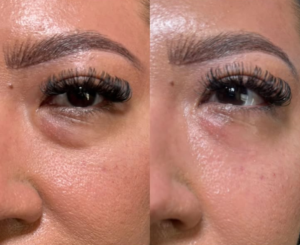 PRP undereye