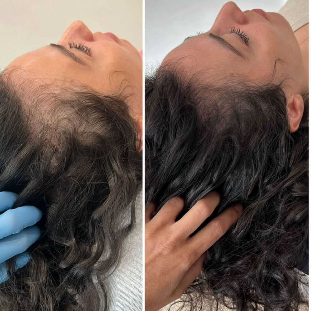 Hair Growth Microneedling Treatment at Amethyst Spa in Omaha, NE