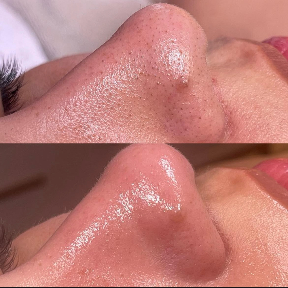 Facial Vacuuming
