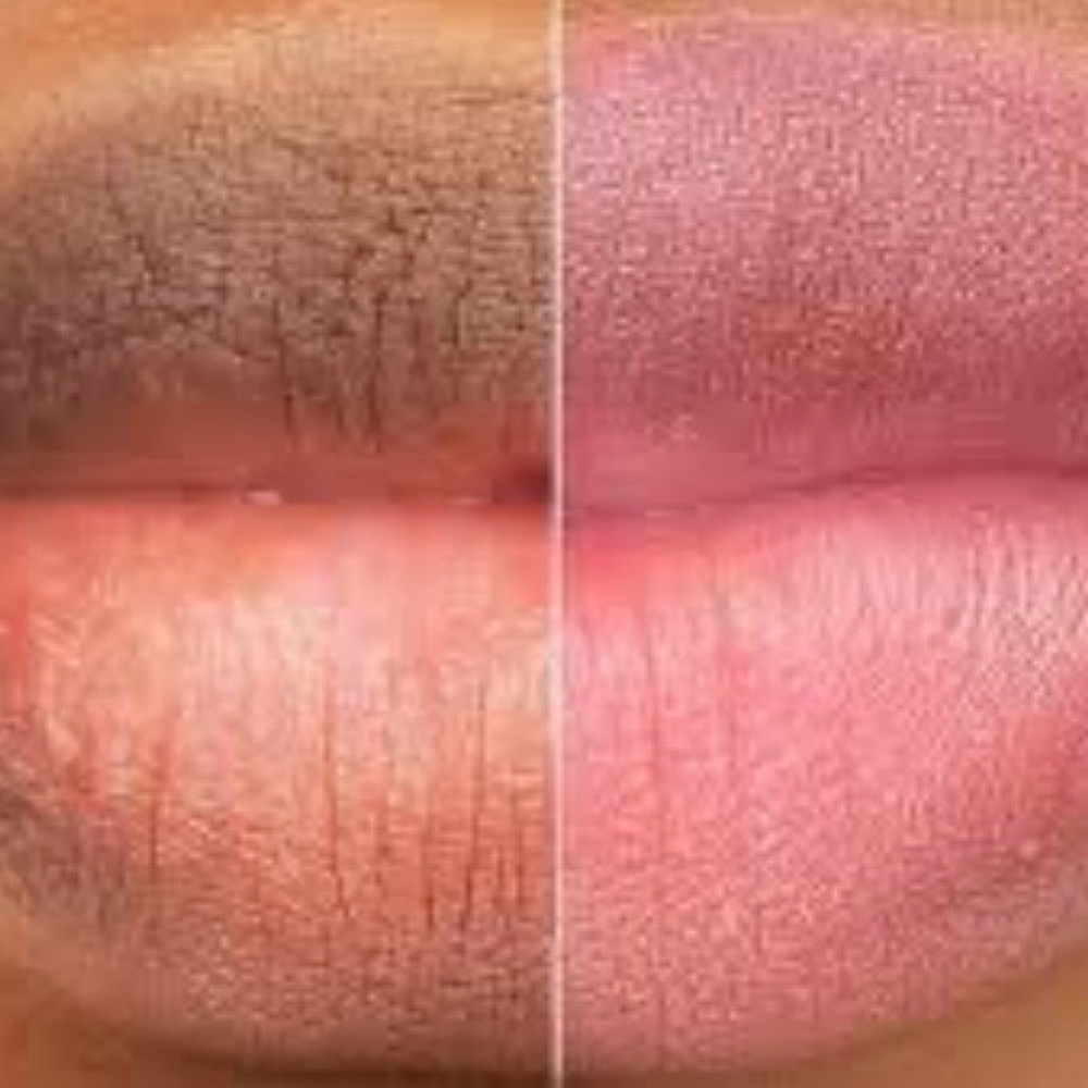 Lip Neutralization at Max Beauty Retreat in Tampa, FL