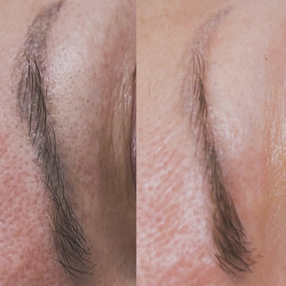 Tattoo Lightening/removal at The Beauty Spot by Meredith in Freehold, NJ