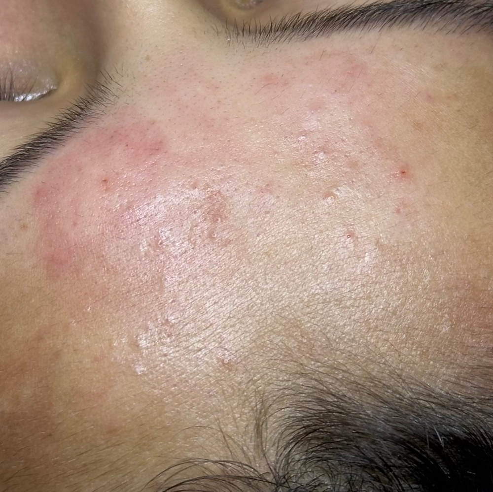 TEEN Customized Facial