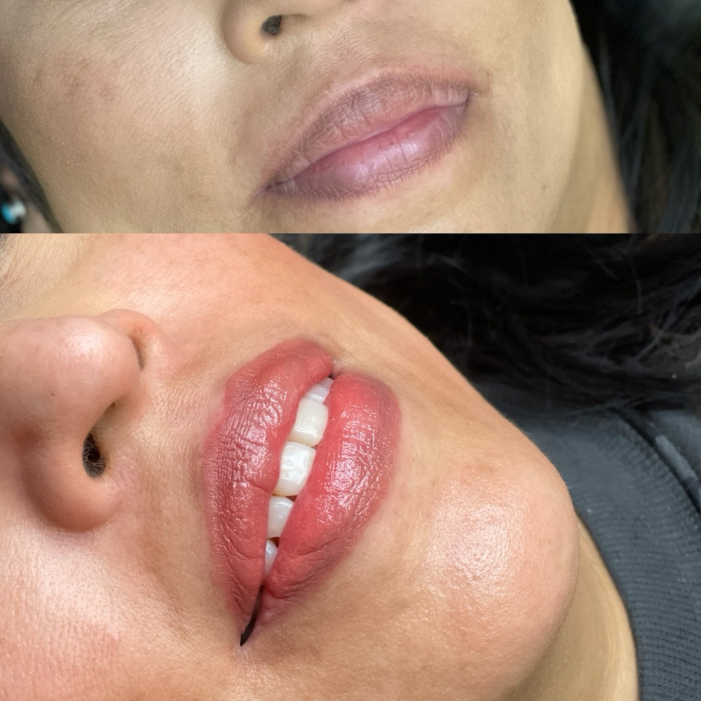 Dark Lip Neutralization