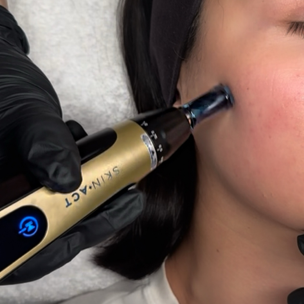 Rain Nanoneedling Facial at Rain Aesthetics in Rancho Cucamonga, CA