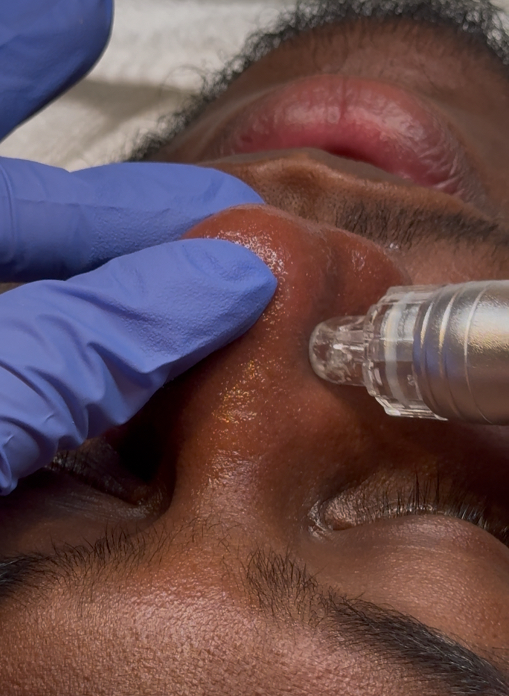 Hydraderm Treatment (8 Weeks)