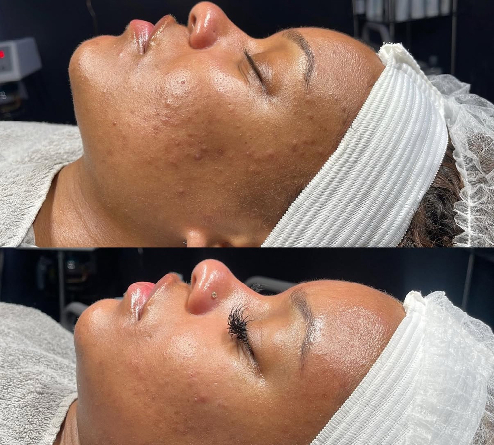 Acne Treatment Facial