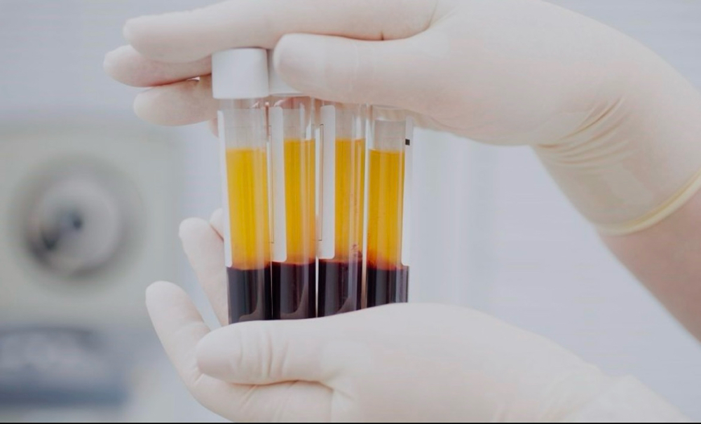 Plasma Rico En Plaquetas at Dream Body Esthetic in Orlando, FL