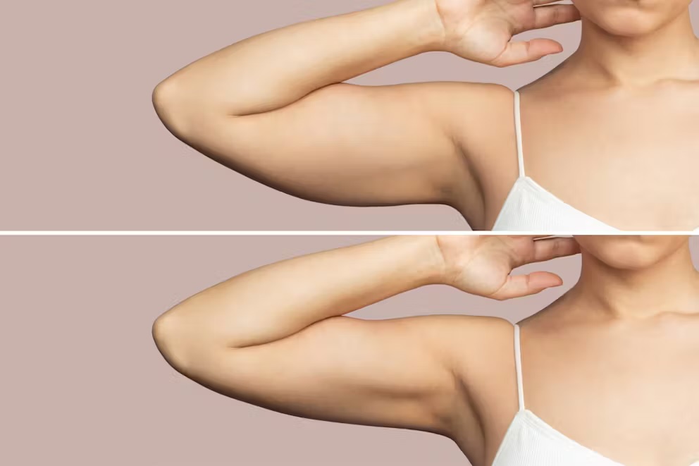 Arm Slimming/Skin Tightening