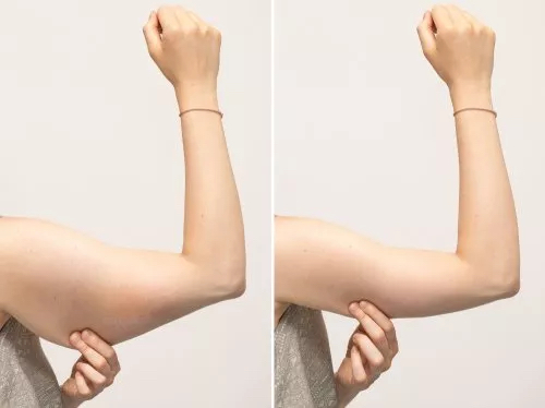 Arm Slimming/Skin Tightening