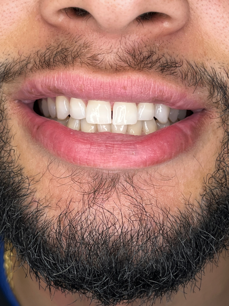 Happy Hour Whitening