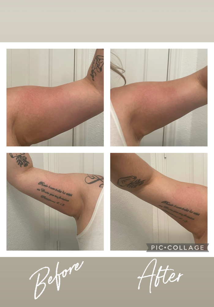 Body Contouring ( Small Section)