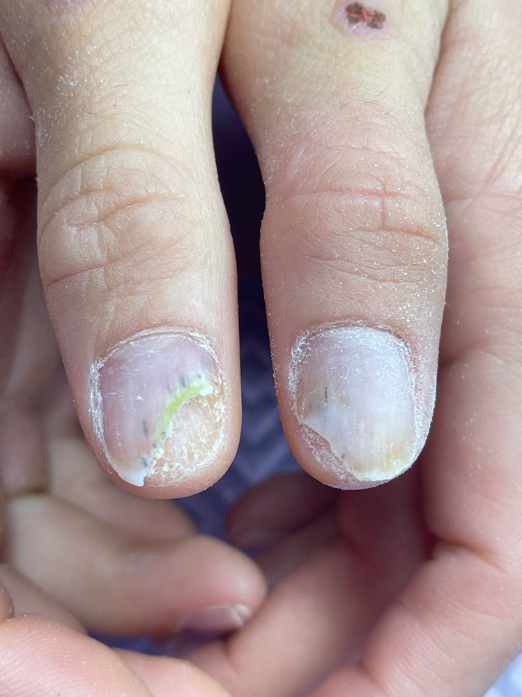 Trat Hongo ParaManos Y Pies Con Kit