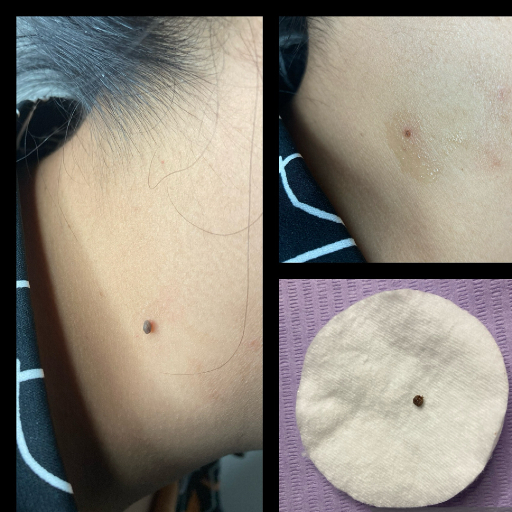 Mole And Skin Tag Removal at Glo’s Beauty Creations