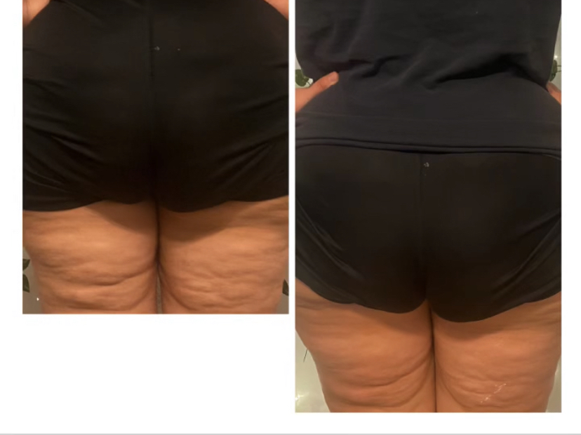 Cellulite Treatment