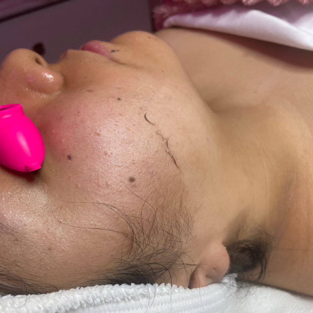 Divine Dermaplaning Facial at Divine Skin Esthetics in San Diego, CA