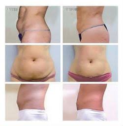 Radio Frequency Skin Tightening